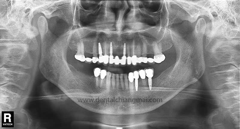 CASE 1 : 5 implants with 3 unit Bridges on upper front maxilla.