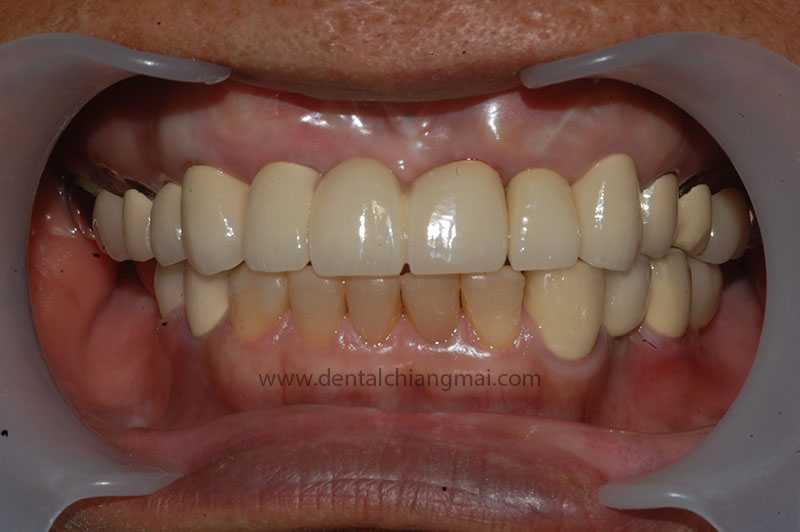 CASE 1 : 5 implants with 3 unit Bridges on upper front maxilla.