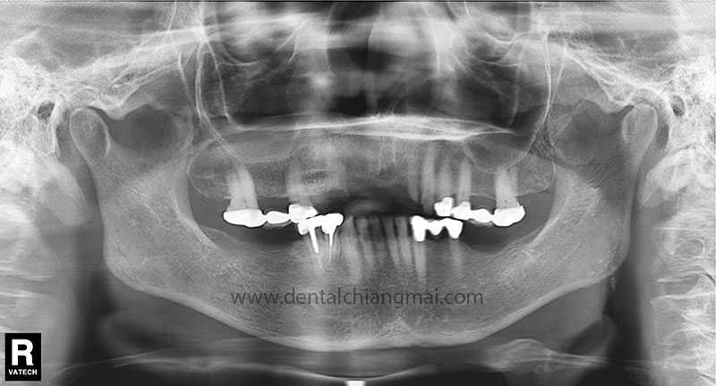 CASE 1 : 5 implants with 3 unit Bridges on upper front maxilla.