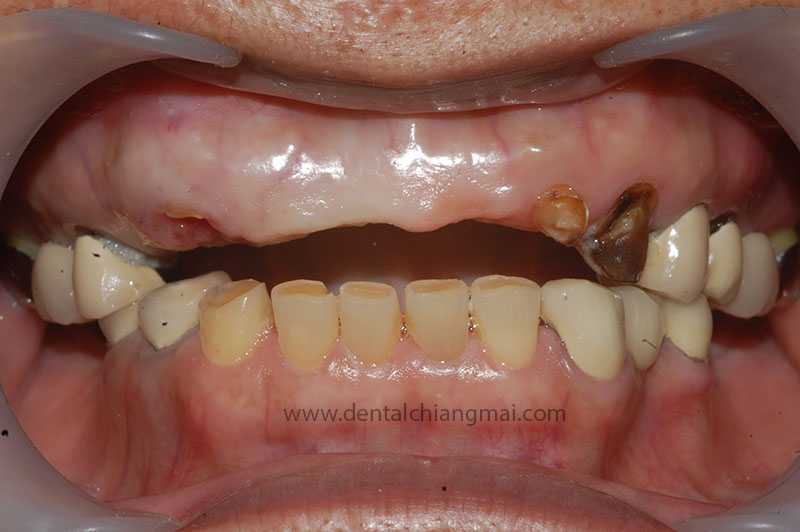 CASE 1 : 5 implants with 3 unit Bridges on upper front maxilla.