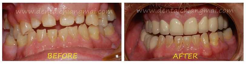 Dental Crowns by Dental Chiang Mai