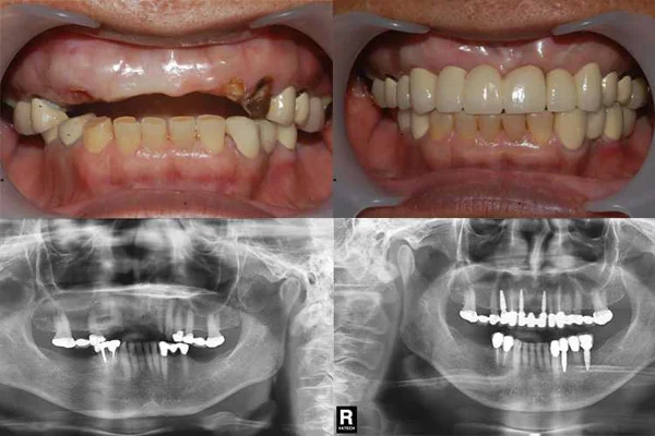 Dental Implant Treatment case 1