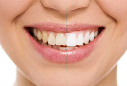 Teeth Whitening Dental Chiang Mai, Thailand Teeth Whitening Dental Chiang Mai, Thailand